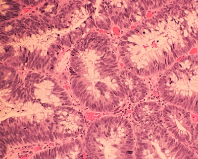 Colonic Adenocarcinoma