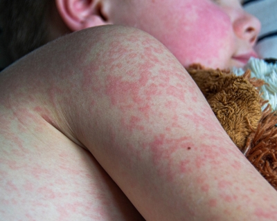 A young child with measles rash all over their body lies in bed and hugs a teddy bear.