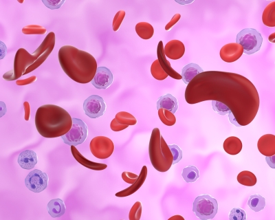 Illustration of red blood cells affected by sickle cell disease.